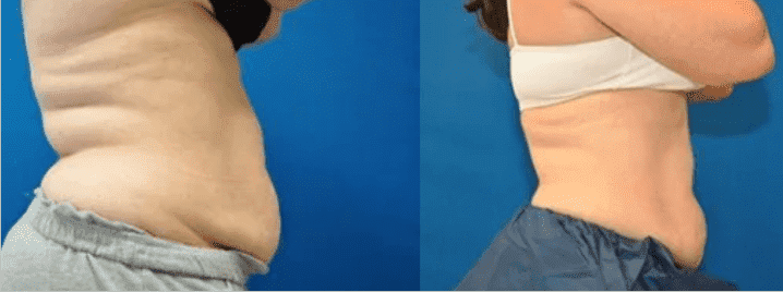ventre avant et après enlèvement de graisse