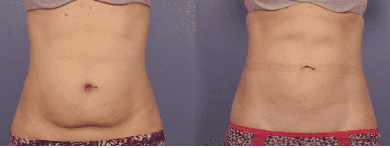 ventre avant et après enlèvement de graisse 2