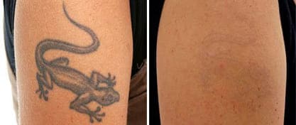 bras avec et sans tatouage de lézard