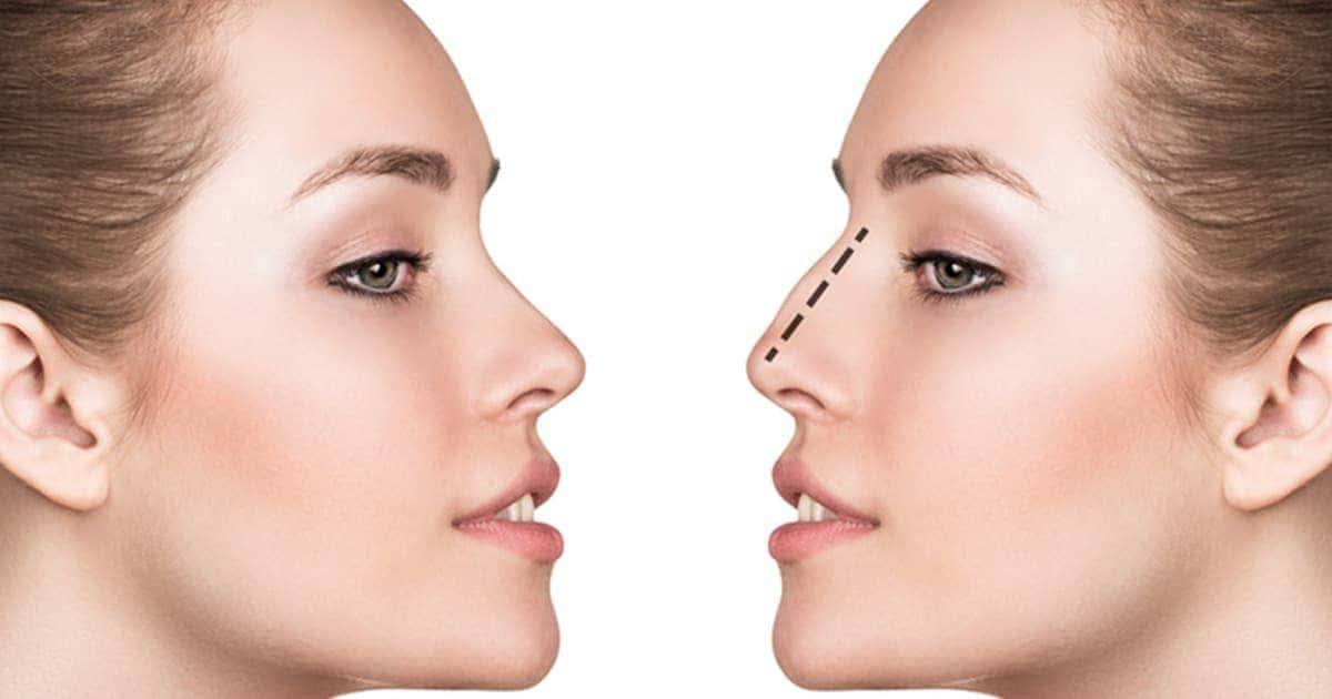 Nez - Rhinoplastie médicale 